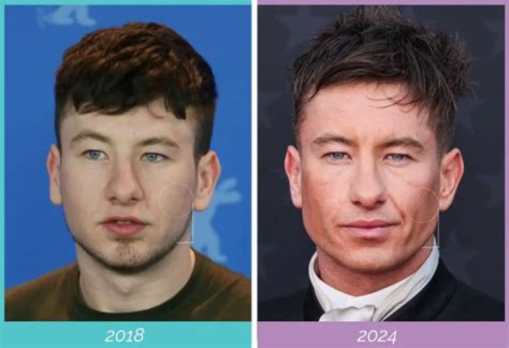 Did Barry Keoghan's Radical Transformation Involve Plastic Surgery?