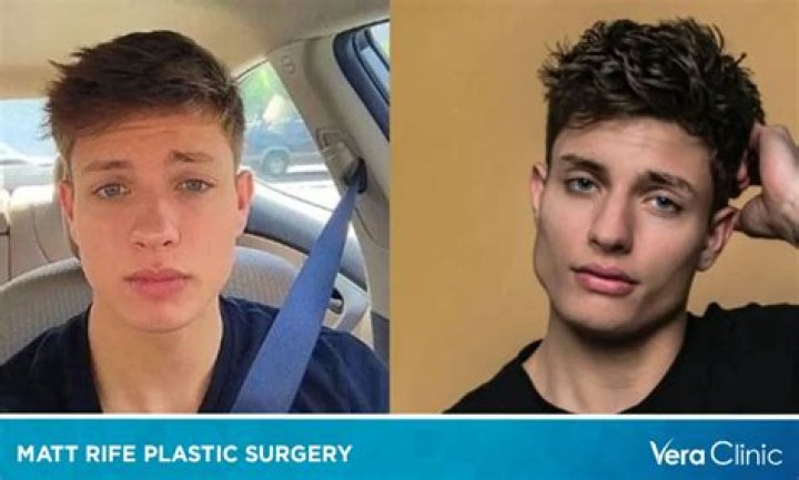 Did Matt Rife Have Plastic Surgery? Before and After Updates ·