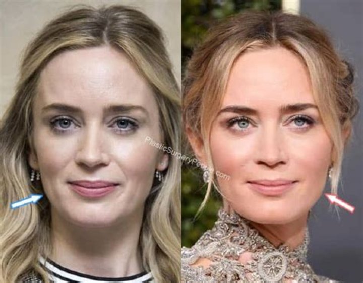 Does Emily Blunt Have Hearing Loss? The Truth Revealed