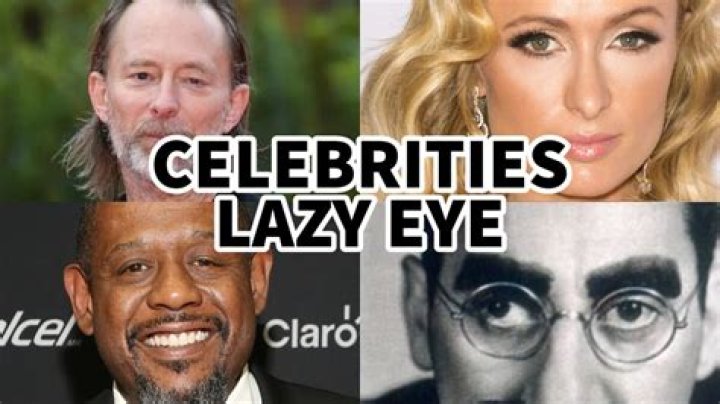 Eye-Catching Celebrities With Lazy Eye