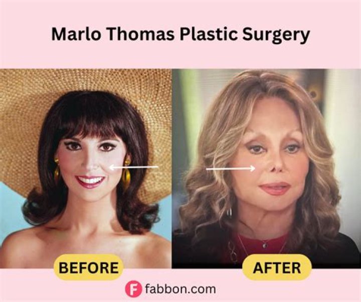 Has Marlo Thomas Undergone Plastic Surgery?
