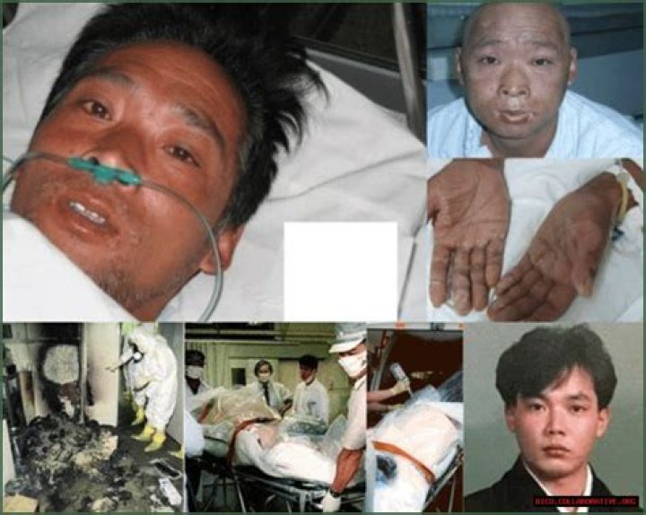 Hisashi Ouchi Medical Photos: A Tragic Case Of Radiation Exposure