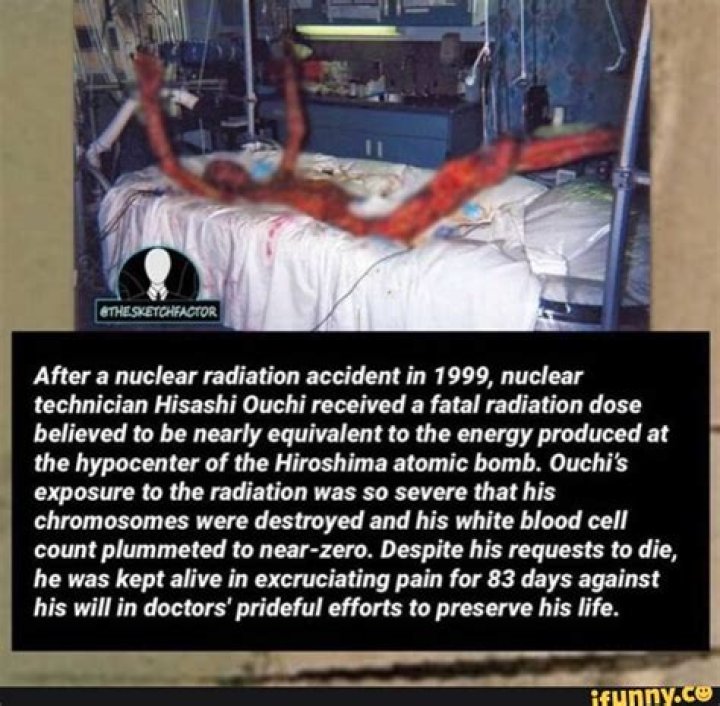Hisashi Ouchi: The Horrific Reality Of Radiation Exposure - True Photos Revealed