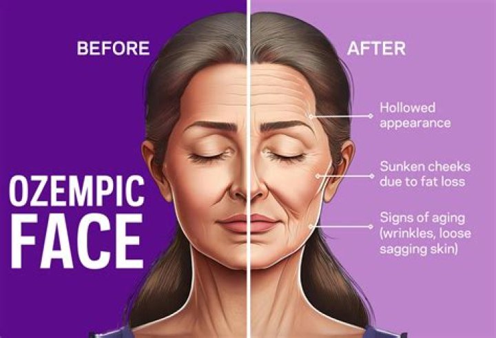 Lupus And Ozempic: Effects And Considerations