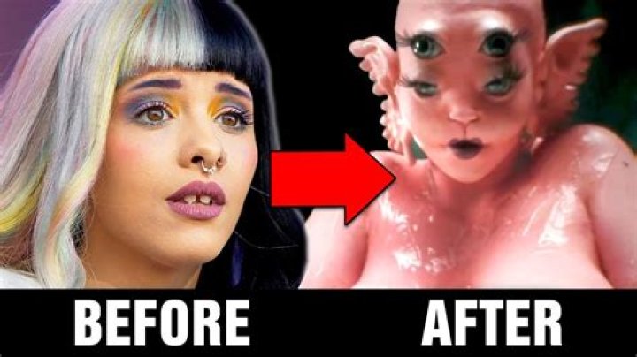The Aftermath: Melanie Martinez After Surgery