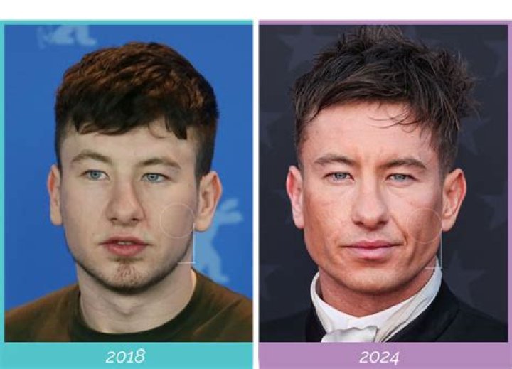 The Truth About Barry Keoghan's Plastic Surgery Speculation
