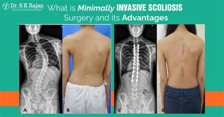 The Ultimate Guide To Scarless Scoliosis Surgery: Transform Your Spine Discreetly