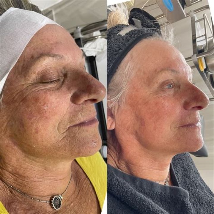 Uncover Joyce Meyer's Transformation: Before And After Plastic Surgery