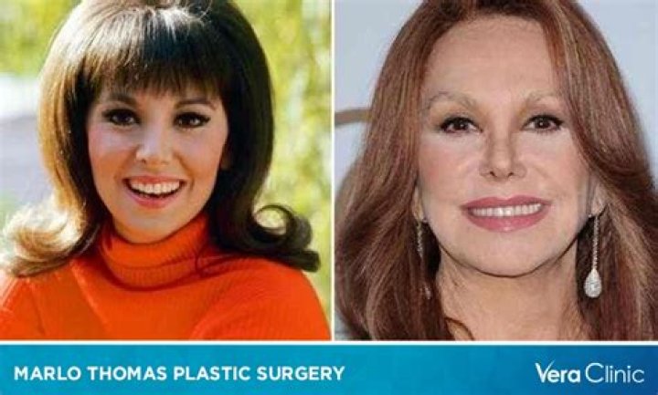 Unveiling Marlo Thomas's Face Surgery: Discoveries And Insights