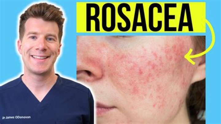 Unveiling The Faces Behind Rosacea: Celebrities' Stories And Surprises