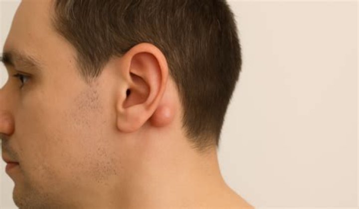 Why Cillian Murphy Has A Lump Behind His Right Ear: The Truth Revealed